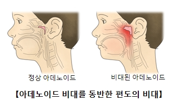 편도 비대, 아데노이드, 소아 코골이
